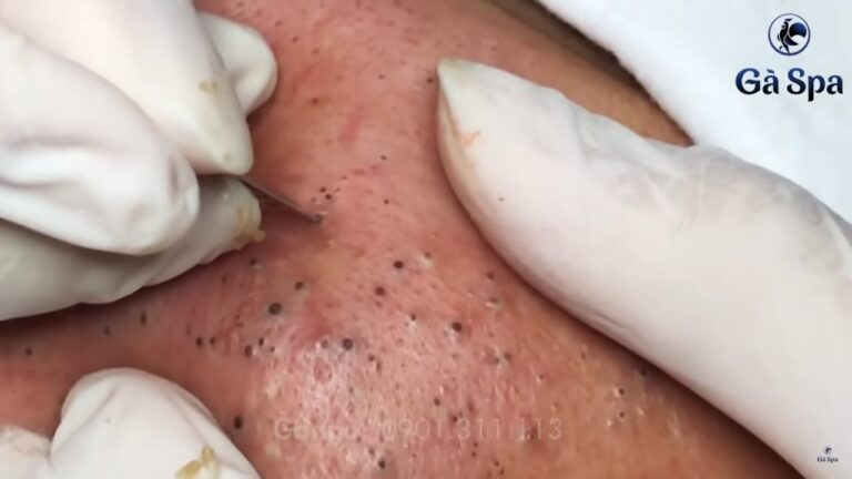 Debunking the Myth: Squeezing Blackheads and Whiteheads Can Cause More Harm Than Good