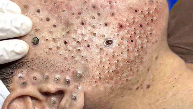 The Difference Between Blackheads and Whiteheads: Understanding the Basics